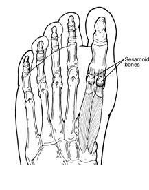Sesamoid Injuries Sesamoiditis: An overuse injury in which chronic inflammation of the sesamoid bones and the tendons surrounding them result in dull pain felt in the 1 st MTP joint.
