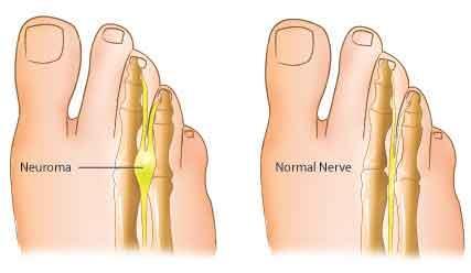 Morton s Neuroma A benign neuroma of a branch of the medial or lateral plantar nerve, most commonly occurring in the space between the 3 rd and 4 th metatarsals Contributing causes include excess