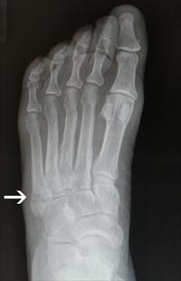 Dancer s Fracture Avulsion fracture of the 5 th metatarsal, creating localized pain, swelling, bruising, and difficulty walking Occurs acutely with an ankle sprain, which differentiates this type of