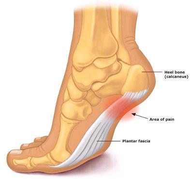 Plantar Fasciitis Inflammation of the plantar fascia (plantar aponeurosis), which causes tightness across the plantar aspect of the foot and pain, most commonly at the heel Caused by overuse and