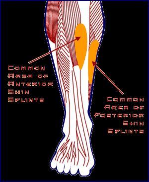 Medial Tibial Stress Syndrome The most common cause of pain over the front of the lower leg (generalized as shin splints) it is an overuse injury which is one of the most common causes of exertional