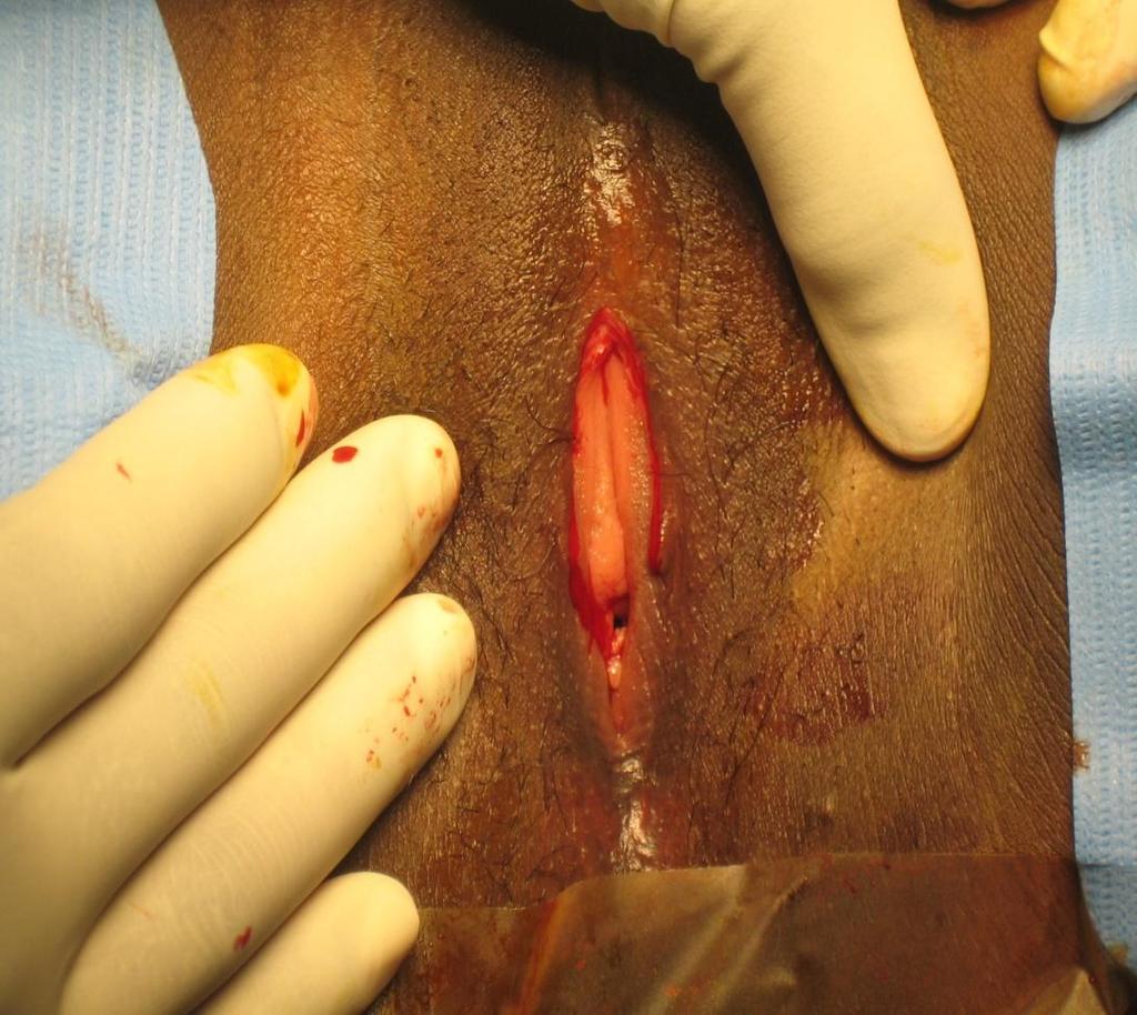 Step 1: prepubic incision The excised area sometimes appears as