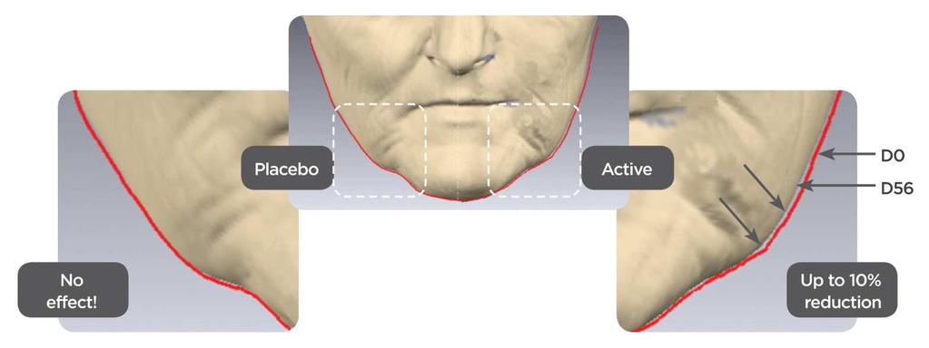 Clinical evaluation of anti-sagging effect on jawlines 1 Protocol 10 healthy volunteers: 54-64 years old with aged skin Formulation: 2% TT-2 peptide emulsion cream or placebo Application: split-face