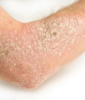 predisposition Dry skin Eczema or