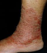 Lichenification Rough, thickened epidermis Ex: chronic dermatitis, eczema Denuded/Excoriation