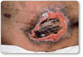 subcutaneous tissue and these ulcers can be shallow.