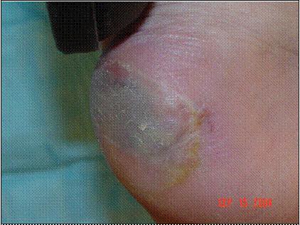 Unstageable Suspected Deep Tissue Injury Purple or maroon localized area of