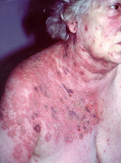 silver Bacterial Viral Fungal Cellulitis: Diffuse, acute infection of skin or SQ tissue Pathophysiology: Group A Beta-hemolytic