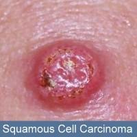 an ulcer Squamous Cell Carcinoma Malignant tumor of epidermal layer Prolong exposure to UV light, tanning beds Head, neck, hands, scalp, arms, back, shoulders, rim of ears, lower lip Fast growing Can