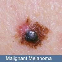 Malignant Melanoma Burns Severity: Depth of burn Percent of tissue involvement Part of body burned Cause Age Types: Thermal Radiation Chemical Electrical Rule of Nines: Entire head 9%, Entire trunk