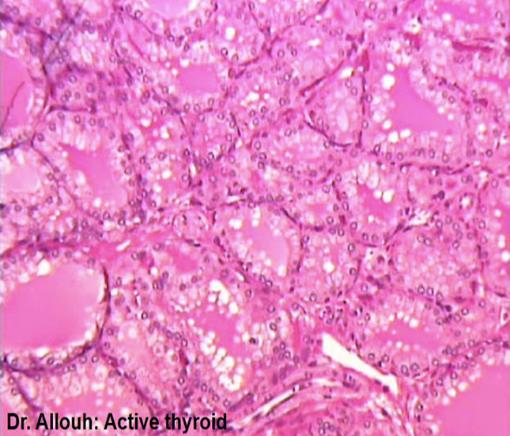 ; The shape of the thyroid follicular cells is different according to the activity of the cell; Squamous or flattened cells: this indicates an inactive or hypothyroidism status (don t produce a