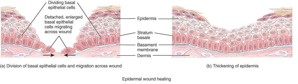 EPIDERMAL WOUND HEALING o Abrasion or minor burn o Basal cells migrate across the wound contact with other cells stops migration EGF stimulates basal cells to divide