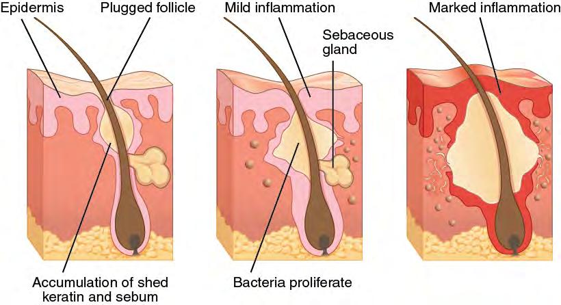 204 Chapter 5 The Integumentary System Figure 5.22 Acne Acne is a result of over-productive sebaceous glands, which leads to formation of blackheads and inflammation of the skin.