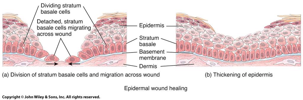 1/24/13 4 phases of Deep Wound Healing Epidermal Wound healing Epidermal wounds = abrasions, minor burns When