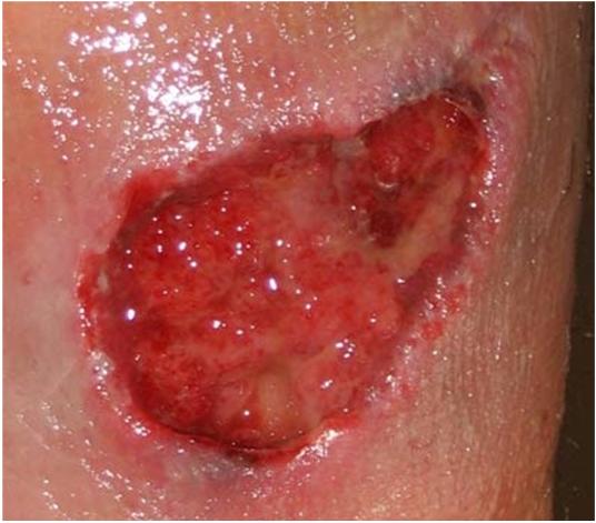 PhagocyIc white blood cells engulf bacteria. Heat, redness, pain. Migra(on clot becomes scab.