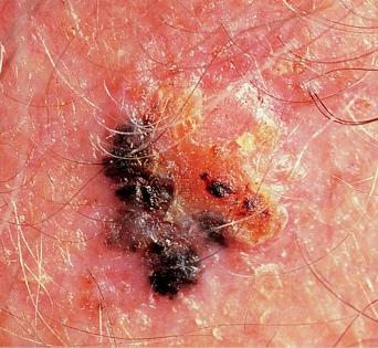Laser therapy 24-27 24-28 Skin Cancer: Squamous Cell Carcinoma Less common than basal cell carcinoma Found on