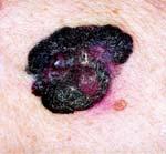 Skin Cancer: Malignant Melanoma Signs and Symptoms From melanocytes Appear on trunk, head, neck of men Appear on arms and legs of women Itches or bleeds Treatment Surgery and biopsy Removal of lymph