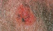 00020001027174854_CH05.pdf 5/23/2012 9:07:07 AM 14 Unit 2 Covering, Support, and Movement of the Body (a) Basal cell carcinoma Figure 5.8 Photographs of skin cancers.
