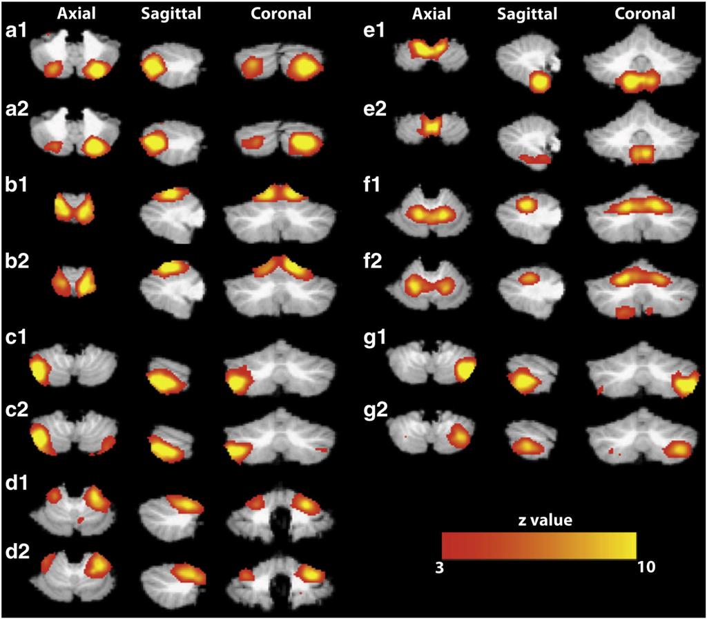 V.I. Dobromyslin et al. / NeuroImage 60 (2012) 2073 2085 2077 Fig. 3. Consistent group-level independent components in the cerebellum for replication Group 1 and Group 2 using crbl-ica.