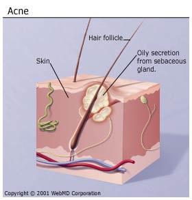 Acne Failure of hair follicle to properly