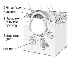 Blackhead: A blackhead occurs when the trapped sebum and bacteria partially open to the surface and turn black due to