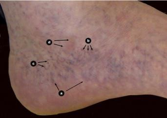 PROGRESSION OF VEIN DISEASE CHRONIC VENOUS INSUFFICIENCY Skin changes Corona phlebectatica