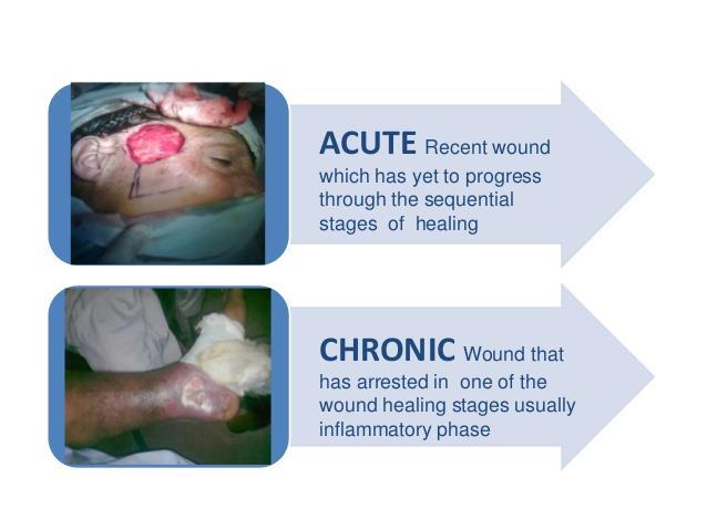 1,2. Acute versus Chronic Wounds Despite the fact that there is no specific time frame that clearly differentiates an acute from a chronic wound, some suggest