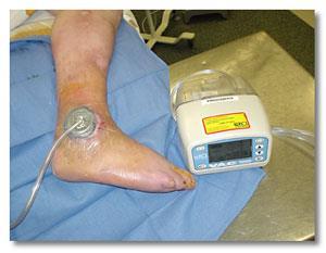 Wound Vac Therapy
