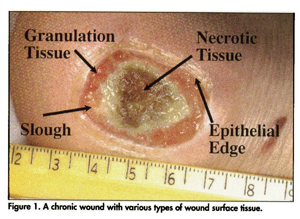 Chronic Wounds Affects approximately 5.
