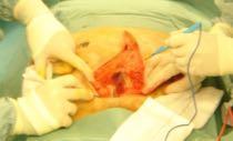 FROM OPEN SURGERY TO INCISION-FREE SURGERY Open Prostatectomy Laparoscopic Prostatectomy Robotic Laparoscopic Prostatectomy