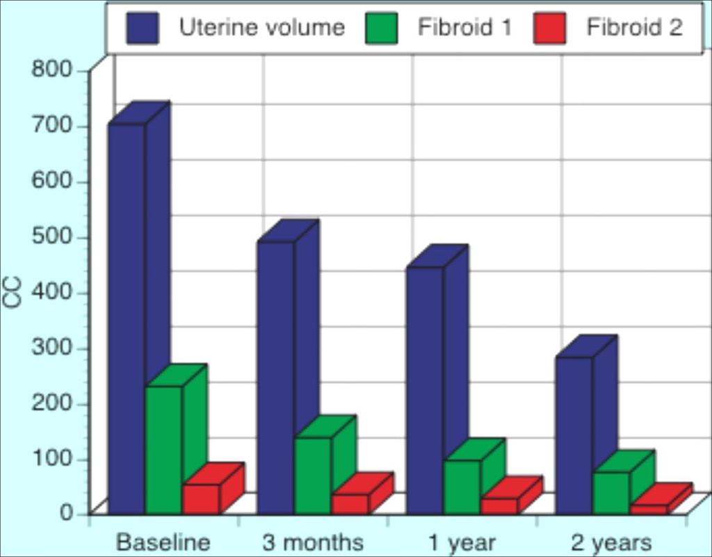 Uterine Fibroid Embolization Successfully treated