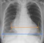 6/16/2016 Chest X-Ray Establish baseline Assess the following: - Cardiac shape/size - Pulmonary vasculature - Pulmonary infiltrates/congestion - Pleural effusion - Device and lead position