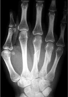 302 P.URGE Figura 1. Closed comminuted shaft fractures of the long and ring metacarpals, with shortening and angulation () requiring plate stabilisation ().