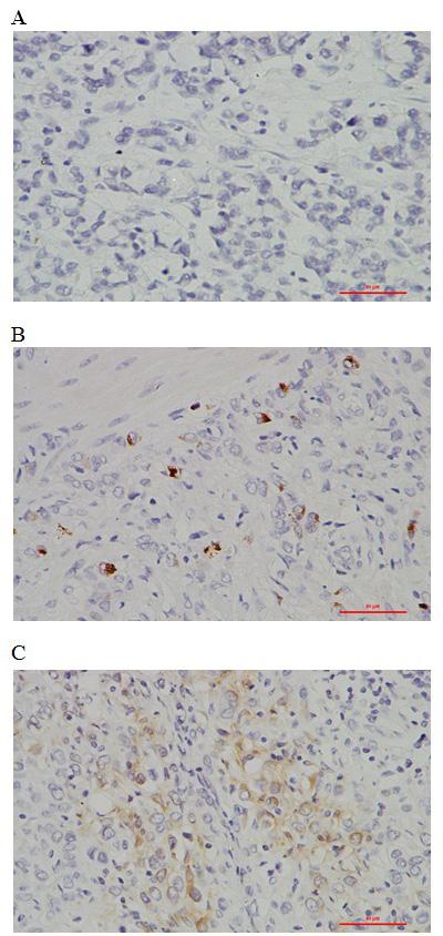 Chang/Huo/Lv/Shan/Liu In this study, we examined the ALK fusion gene using conventional IHC in signet-ring cell gastric carcinoma and analyzed the correlation between ALK fusion gene and