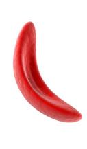 What is sickle cell disease? Sickle cell disease changes the shape and texture of hemoglobin, which is a protein in red blood cells.