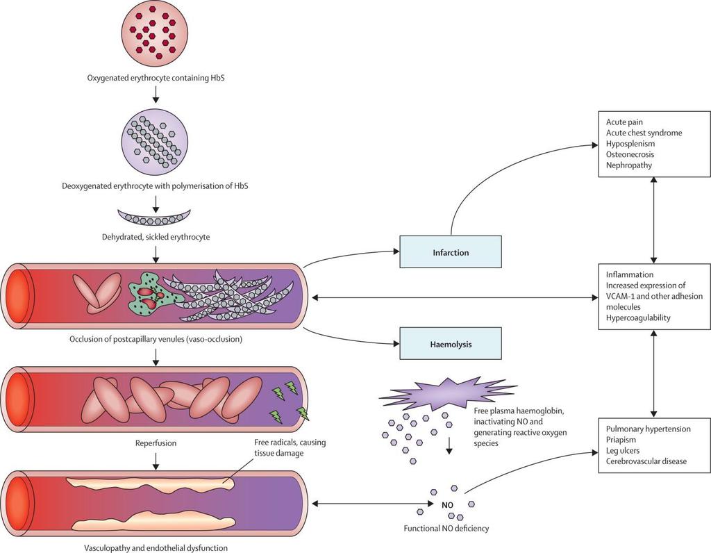 Pathophysiology Sickle-cell disease. Piet et al.