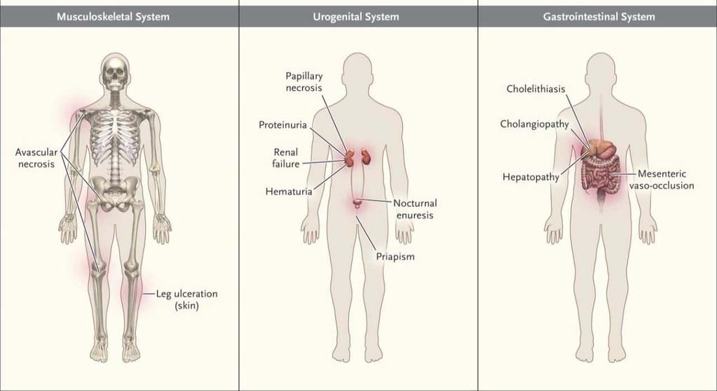 Common Clinical Complications of Sickle Cell