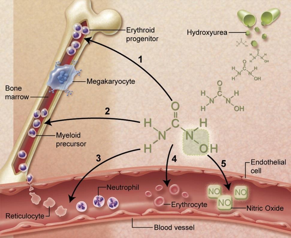Hydroxyurea Mechanisms of action Multiple beneficial effects 1. HbF induction in erythroid precursors 2. Lower neutrophil and reticulocyte counts 3.