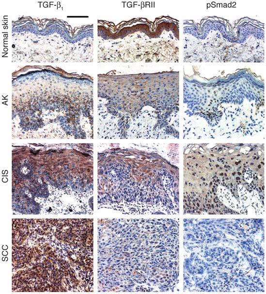 Figure 1 Immunostaining for TGF-β 1, TGF-βRII, and psmad2 in human skin cancer samples revealed a patchy increase in TGF-β 1 and decrease in TGF-βRII staining in AK and CIS, and the same alterations