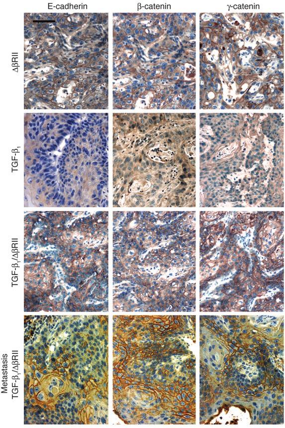 Figure 6 Immunohistochemical staining for E-cadherin and β- and γ-catenins in primary SCCs from βrii-, TGF-β 1, and TGF-β 1/ βrii transgenic mice 25 weeks after DMBA initiation and in a lymph node