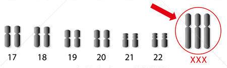 V. Chromosomal AlteraDons 1. Aneuploid Disorders e.