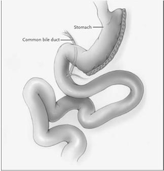 Sleeve Gastrectomy Treadwell et al, Ann Surg, 2008 Weight loss mechanism Reduced gastric