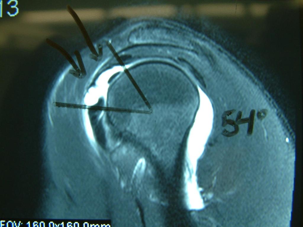 Morgan Arthrogram MRI - Sagittal Oblique Images