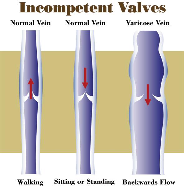 What is a Varicose Vein?