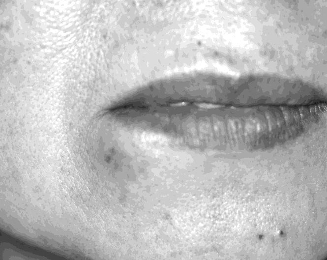 110 K. Mori et al. / Open Journal of Stomatology 1 (2011) 109-113 Figure 1. Extra oral view at first visited, showing swelling on the right side of the lower lip. Figure 2.