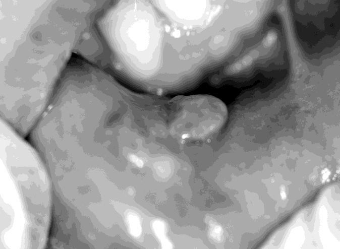 MRI findings revealed a high signal in the tumor mass in a T2 weighted image (T2 weighted MRI image). as they may rarely arise in the lower lip [3].