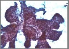 Adenoid cystic carcinoma Epithelial-myoepithelial