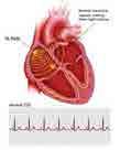 Electrocardiography Basics Heart Rate Heart rate = 1500/13 = 115 bpm Instantaneous 25 mm/s = 1500 / # small
