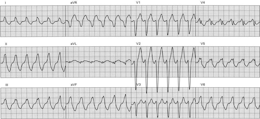 Idiopathic VT from RVOT - 70% of all idiopathic VTs - women > men - typical trigger = exercise