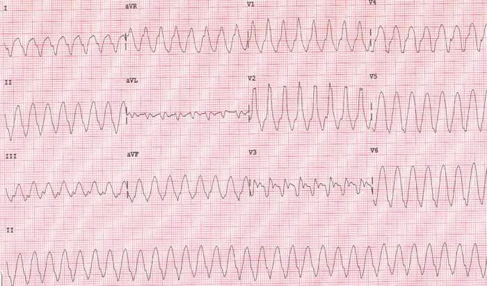 Ventricular tachycardias (VTs) Organised ventricular activity ( 3 beats) with heart rate > 100 bpm QRS >